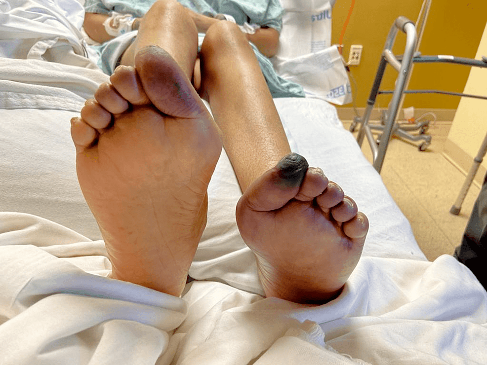 Diagnosis dan Manajemen Sindrom Antifosfolipid Katastrofi (CAPS) dan Pengaruhnya terhadap Kriteria Klasifikasi APS ACR/EULAR&nbsp;2023