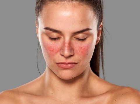 Faktor Prediksi Flare pada Pasien SLE Selama Pemantauan Rutin Pasca&nbsp;Remisi